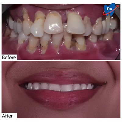 Dental Implants in Mangalore: Before & After