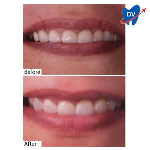 Cosmetic Dentistry in Mangalore, India: Before & After
