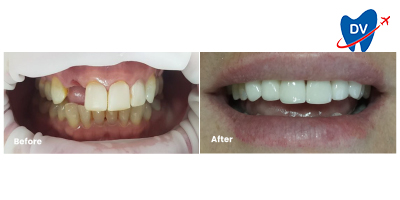 Dental Implants in Indonesia: Before & After