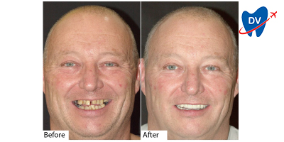 Full mouth restoration in Mumbai - Before & After