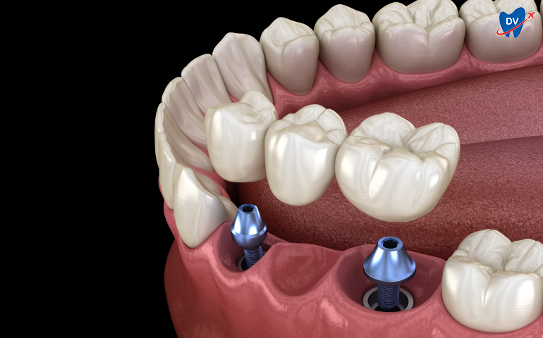Implant-supported dental bridge in Mumbai