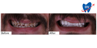 Before and After Hollywood Smile in Istanbul | Dental Work in Istanbul Reviews