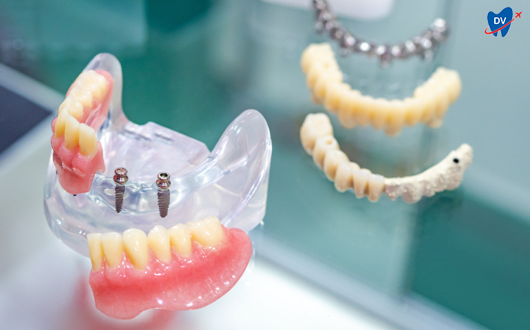 Mini Dental Implants in Indonesia