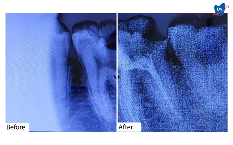 Root Canal Treatment in Mangalore, India: Before & After 