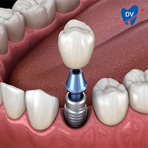 Single Dental Implant in Bodrum, Turkey