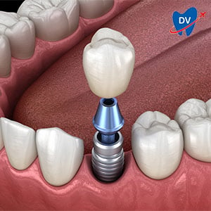 Dental Implant