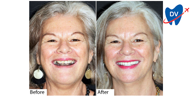 Smile makeover in Mumbai - Before & After