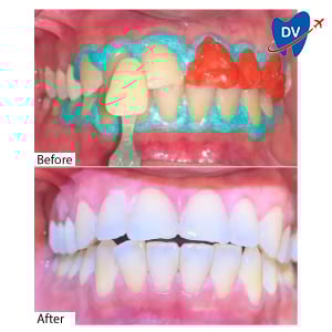 Teeth Whitening in Mangalore, India: Before & After