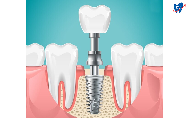 Titanium-dental-implants-