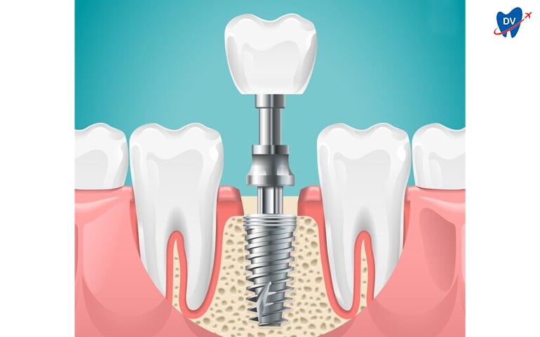 Titanium Implants in Indonesia