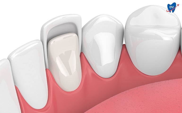 Ceramic Veneers