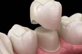 Dental Crown