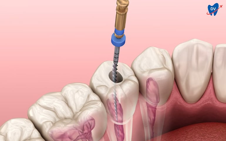 root-canal-treatment