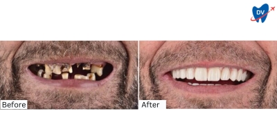 Before and After Dental Implants in Bodrum Turkey