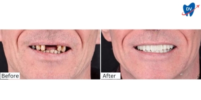 Before and After Dental Implants in Bodrum Turkey