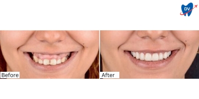 Before and After Dental Crowns In Bodrum, Turkey