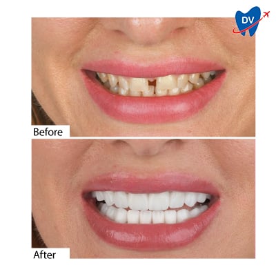 Dental Crowns in Antalya, Turkey - Before & After