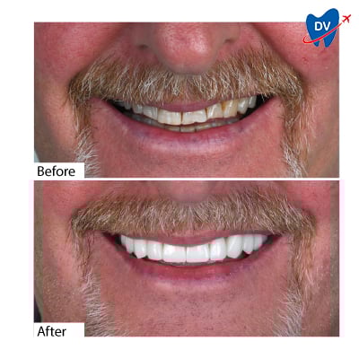 Dental Crowns in Antalya, Turkey - Before & After