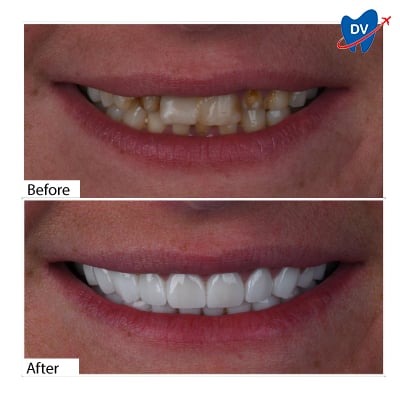 Dental Crowns in Antalya, Turkey - Before & After