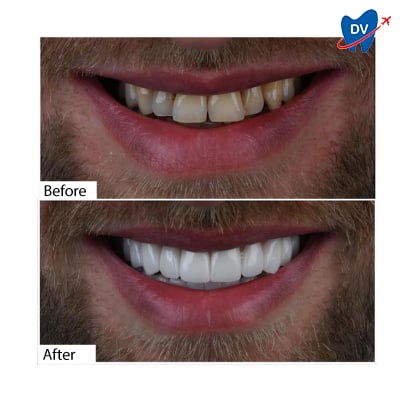 Dental Crowns in Antalya, Turkey - Before & After