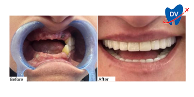 Dental Implants in Didim, Turkey: Before & After