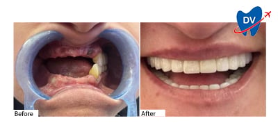 Dental Implants in Didim, Turkey: Before & After