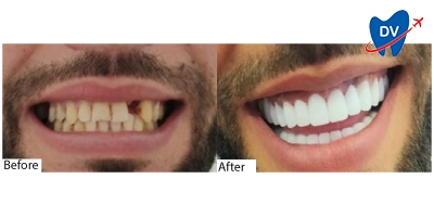 Dental Implants in Didim Turkey: Before & After