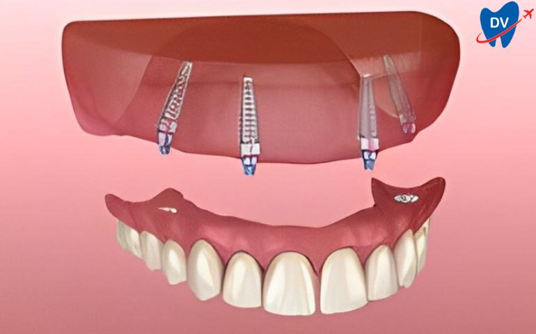 All on 4 Dental Implants in Ankara, Turkey