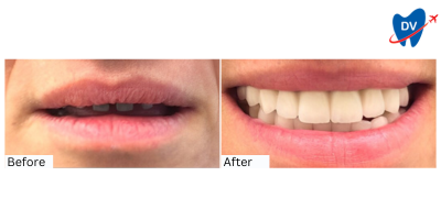 Before & After: All on 4 Dental Implants in Tekirdag