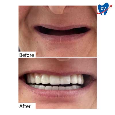 All on 4 Dental Implants in Didim, Turkey: Before & After All on 4 Dental Implants in Didim, Turkey: Before & After