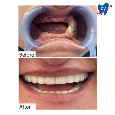 All on 4 Dental Implants in Didim, Turkey: Before & After All on 4 Dental Implants in Didim, Turkey: Before & After