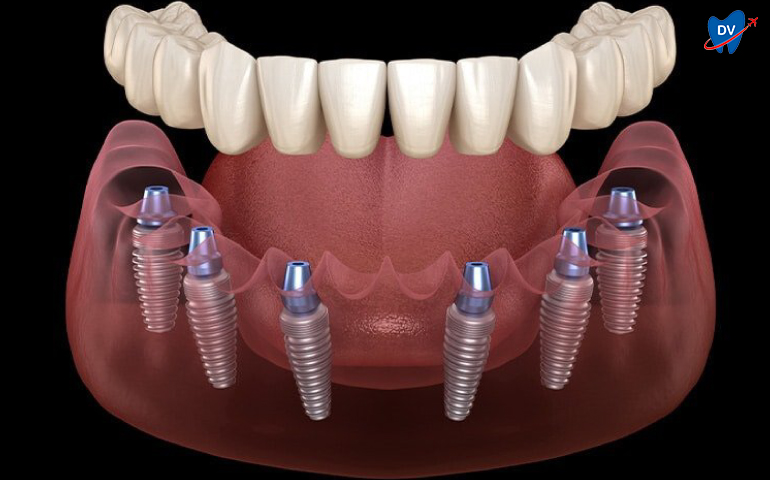 All on 6 Dental Implants in Kusadasi, Turkey