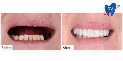 Before and after all on 4 dental implants in Bodrum, Turkey