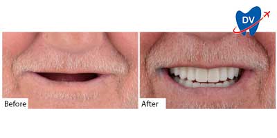 Before and after all on 4 dental implants in Bodrum, Turkey