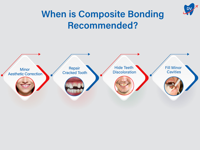 Composite Bonding Recommendations