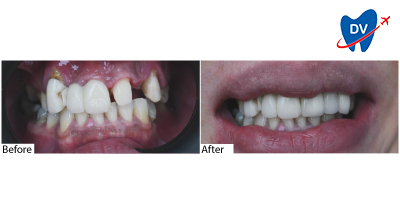 Dental bridge in Malaysia | Before & after