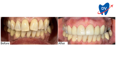 Dental veneers in Malaysia | Before & After