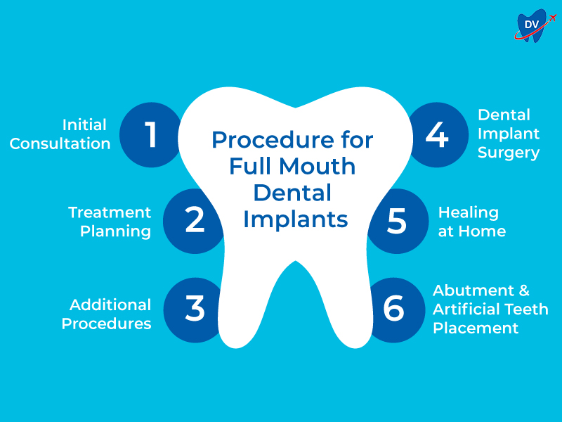 Procedure for Full Mouth Dental Implants