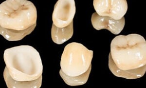 All Ceramic Crowns