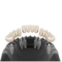 3 on 6 Dental Implants 