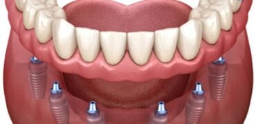 All-on-6 Implants