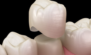 Dental-Crowns