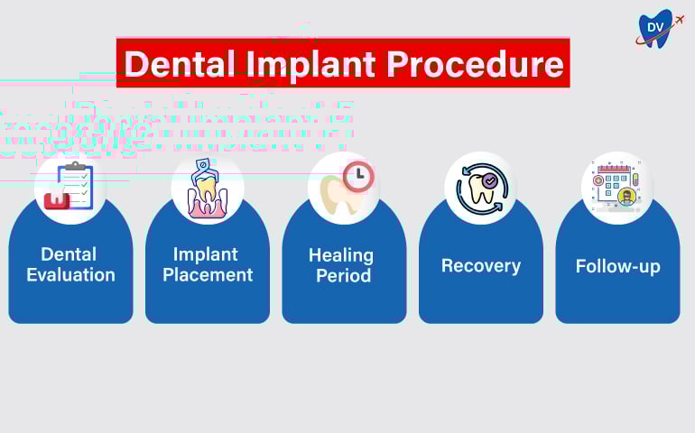 Dental-Implant-Procedure-steps