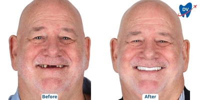 before and after all on 4 in Thailand