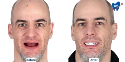 Before & after all on 4 in Thailand