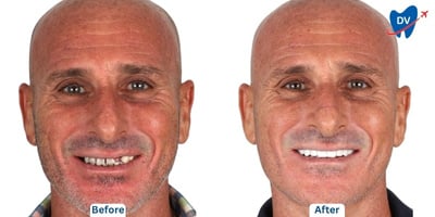 Before & after all on 4 in Thailand