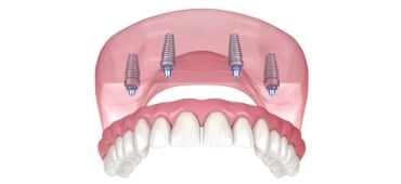 All on 4 implants