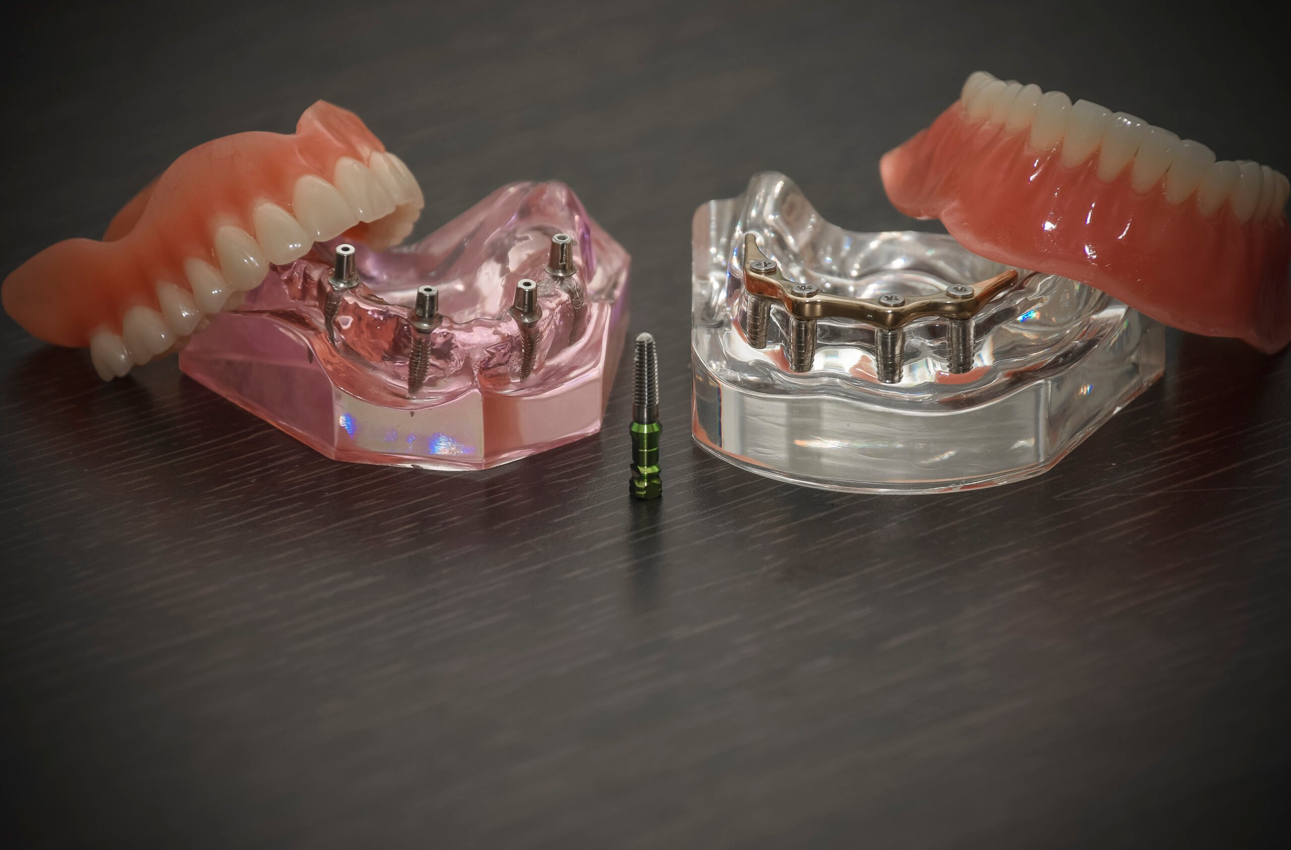 All-On-4 dental implant, with the bridges and titanium implants at ConfiDental, a partner clinic of DentaVacation in Costa Rica.