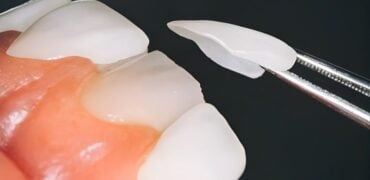 Dental Veneer