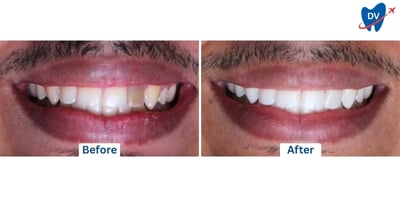 Dental Veneers in Dominican Republic: Before and After